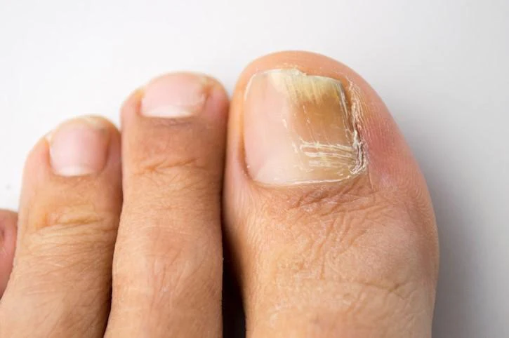 Cómo eliminar los hongos de las uñas de los pies con bicarbonato