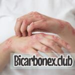 Bicarbonato de sodio para hongos en la piel: remedio natural y efectivo