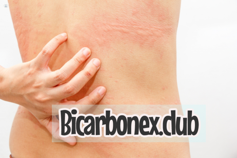 Bicarbonato para la alergia en la piel: remedios naturales y efectivos