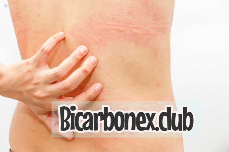 bicarbonato para la alergia en la piel